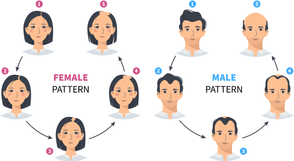 Male & Female Pattern Baldness