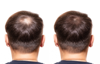 Hair loss comparison