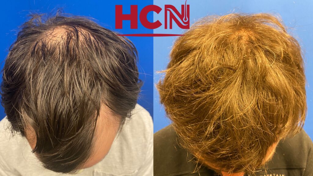 Before-and-after comparison of hair restoration, showcasing significant improvement in hair density and texture. Relevant for promoting hair treatment services.