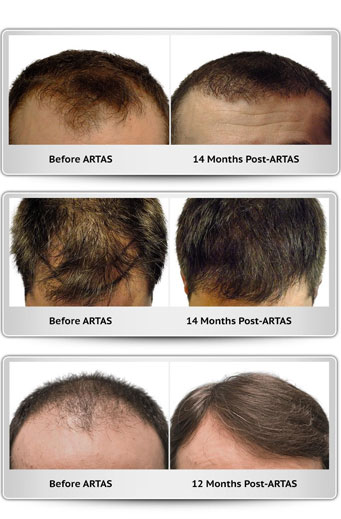 Before-and-after comparison illustrating hair restoration results using ARTAS technology, showing significant improvements in hair density and coverage over time.