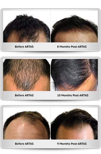 Hair restoration results show before and after images of patients. Progress at 8, 9, and 10 months post-ARTAS highlights improved hair density.