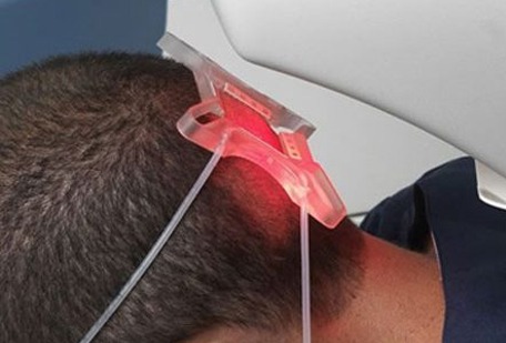 A hair restoration device positioned on the back of a patient's neck, emitting red light for stimulating hair growth during treatment.