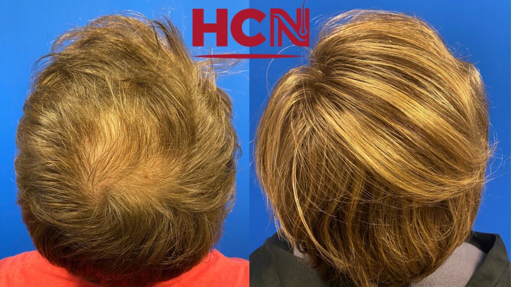 Before-and-after comparison showing hair restoration results. The left side displays thinning hair, while the right side shows a fuller, styled look.
