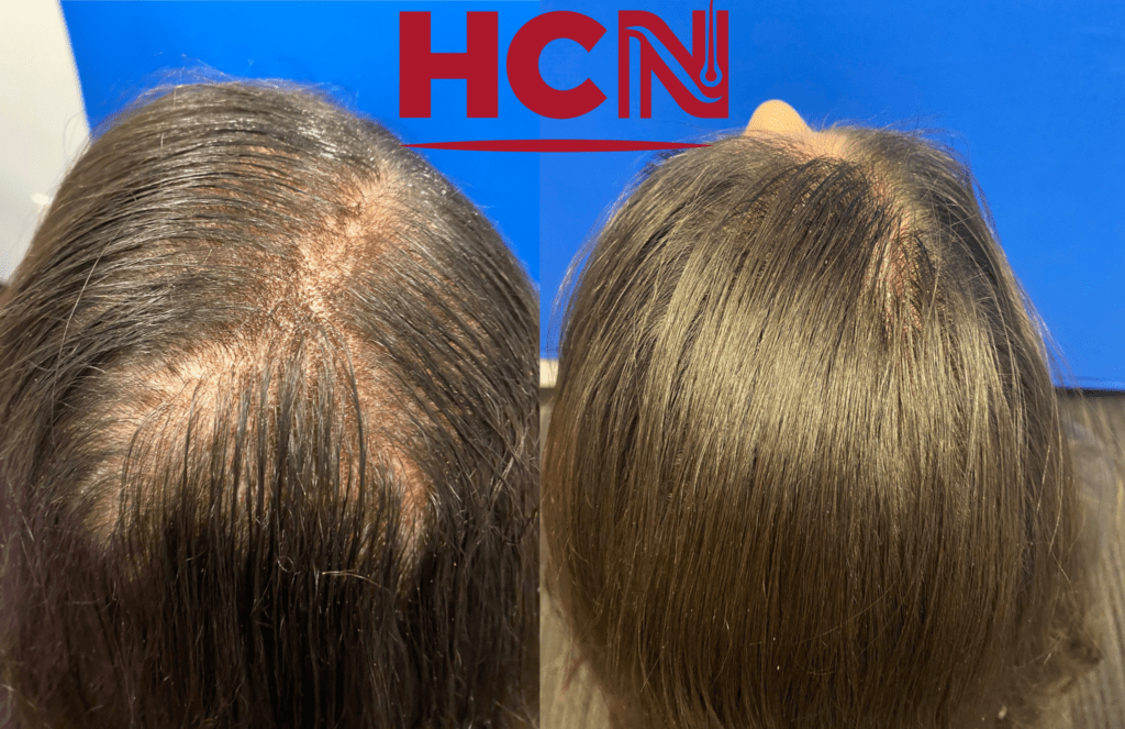 Before and after comparison of hair restoration, highlighting improved scalp coverage and hair density. The image showcases treatment effectiveness.
