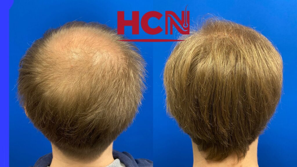 Before-and-after view of a hair restoration treatment, showcasing significant improvement in hair density and style against a blue background.