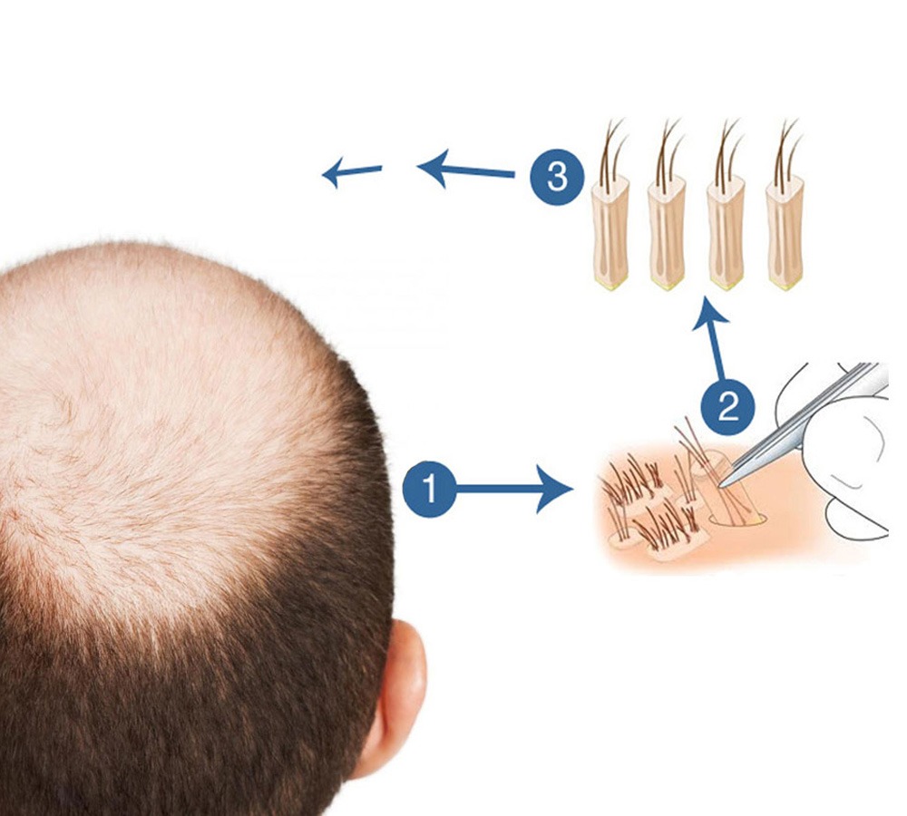 Diagram illustrating hair transplant steps: starting with a bald scalp, followed by hair extraction and implantation processes.