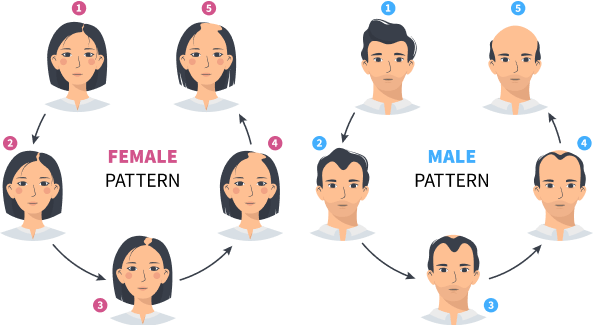 Illustration depicting the inheritance patterns of hair loss in females and males, labeled clearly with numbers and categories for easy understanding.