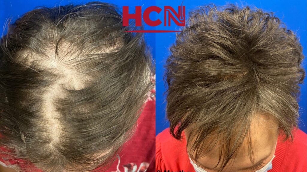 Before-and-after comparison showing improved hair volume and coverage after treatment. Left side features thinning hair, while the right displays fuller strands.