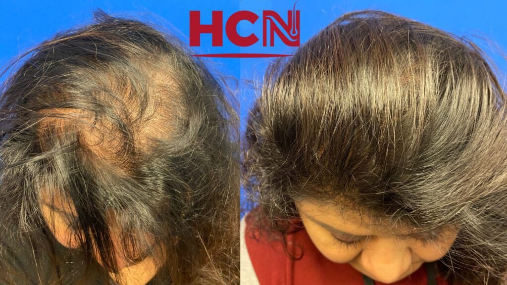 Before-and-after comparison of hair restoration, showing significant improvement in hair density on the right side. Background is solid blue.