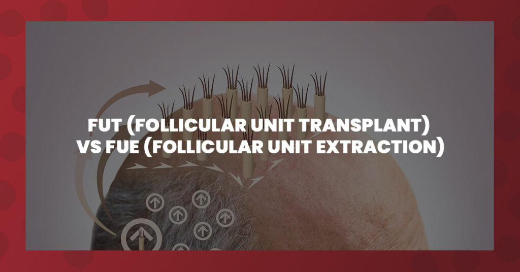 Comparison of FUT (Follicular Unit Transplant) and FUE (Follicular Unit Extraction) hair transplant methods, illustrating hair follicle placement.