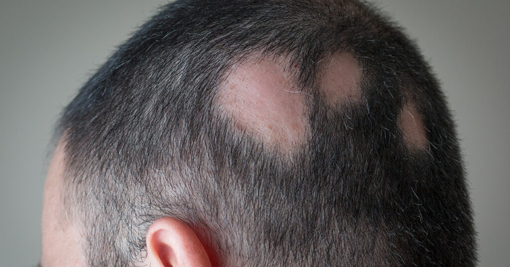Close-up of a man's scalp showing noticeable hair loss with two distinct bald patches. Relevant for discussions on hair loss conditions.