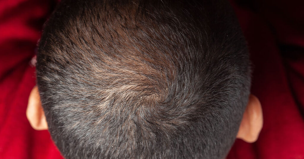 Close-up of a young child's scalp showing dark, short hair with a prominent whirl pattern. The background features a soft red blanket.