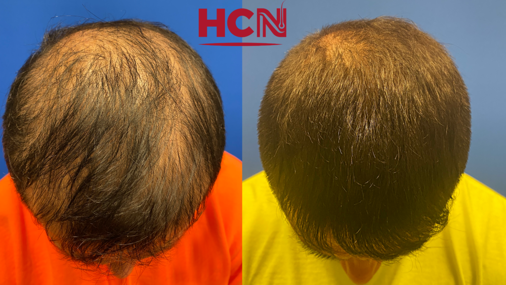 Before-and-after comparison of hair restoration, highlighting significant improvement in hair density and coverage. The left shows thinning hair, while the right reveals fuller hair.