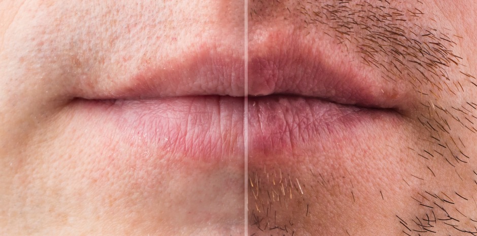 Comparison of two male lips; one side smooth and hairless, the other side showing stubble. Highlights differences in facial hair appearance.