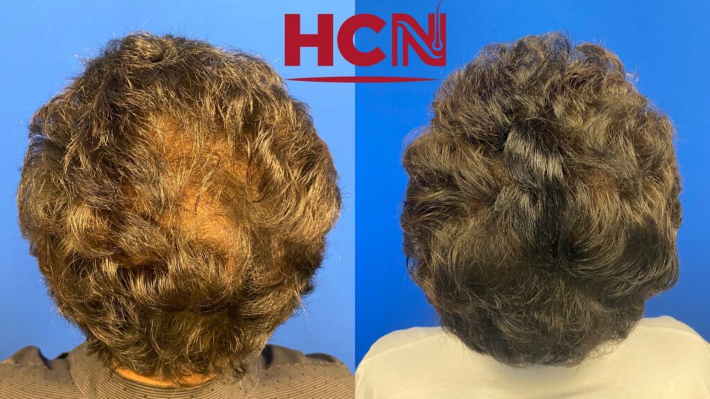 Comparison of two hairstyles showing significant volume and texture difference. The left side displays thinning hair, while the right exhibits fuller, styled hair.