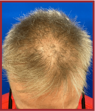 Close-up of a man's thinning hair and bald spot, showcasing light blonde hair against a blue background, relevant for discussions on hair loss treatments.