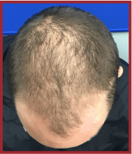 Close-up view of a man’s scalp showing thinning hair, primarily at the crown and front. Highlights hair loss patterns relevant to hair restoration discussions.