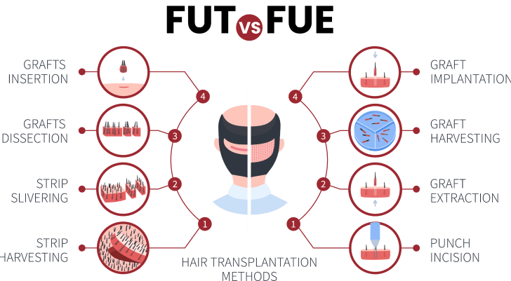 Comparison of hair transplantation methods: FUT and FUE, detailing steps such as graft harvesting and implantation. Useful for understanding procedure differences.