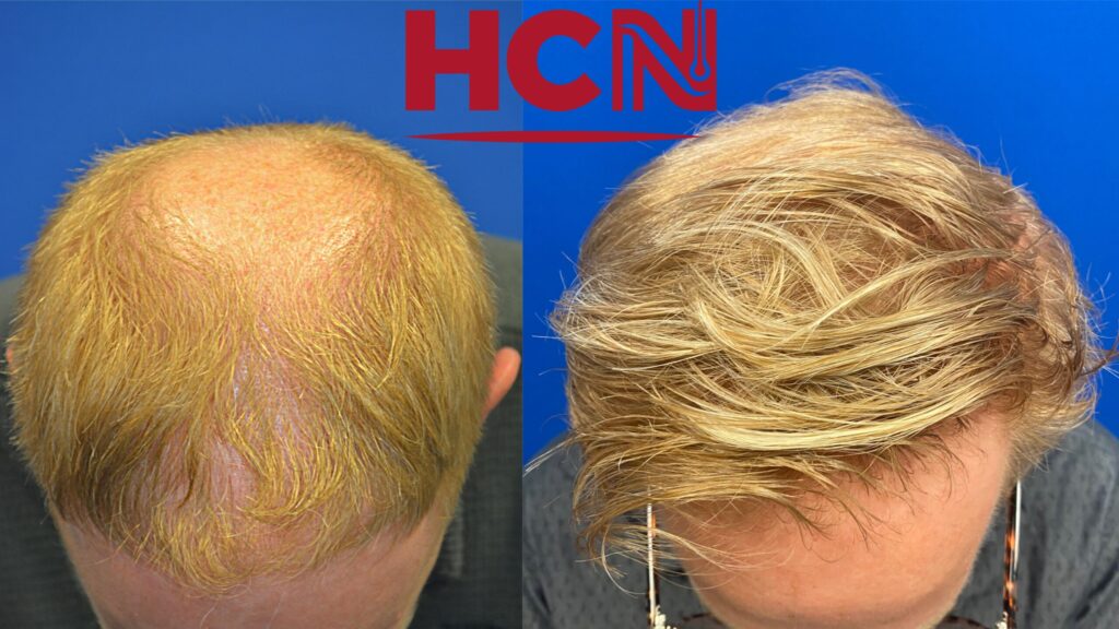Before-and-after comparison of hair restoration showing significant hair growth improvement; relevant to hair loss treatment services.