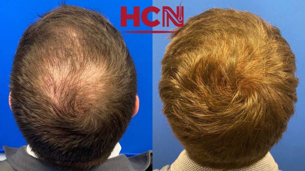 Before-and-after images of a hair restoration treatment, showcasing significant hair growth and improved coverage on the scalp.