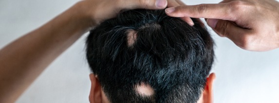 A hand points to noticeable hair loss patches on the back of a person's head, highlighting concerns about scalp health and potential hair restoration solutions.