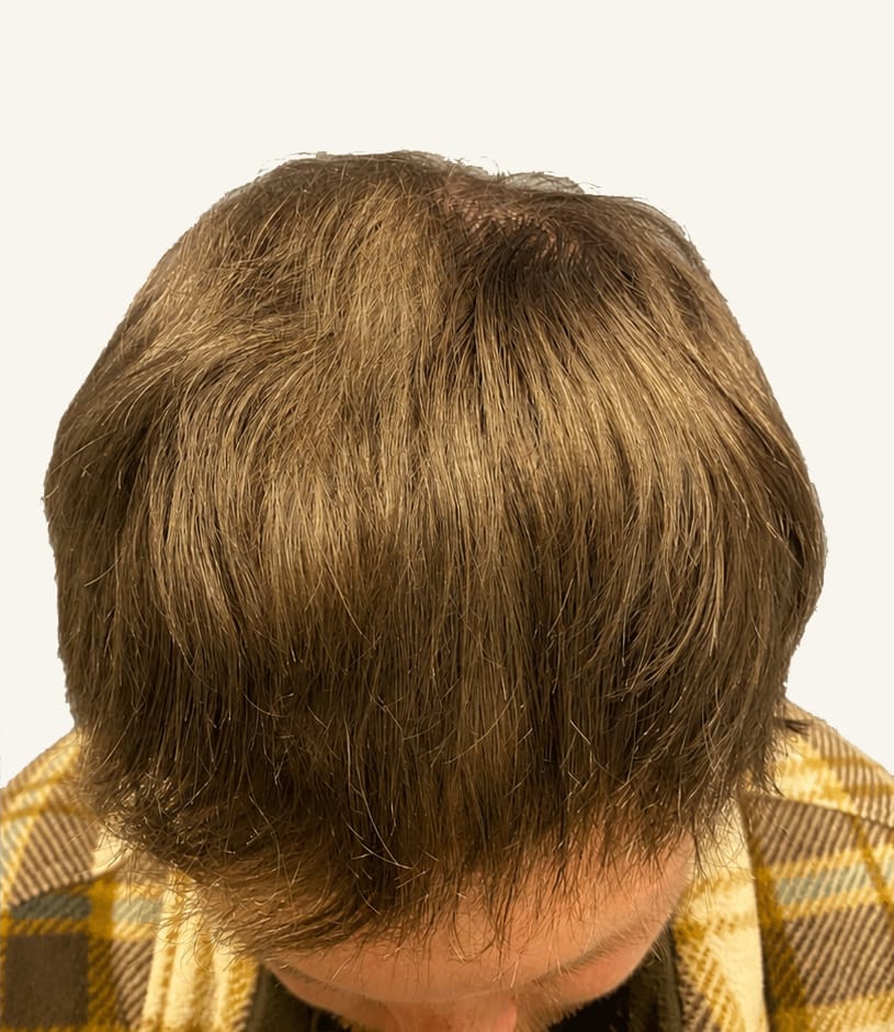 After hair restoration