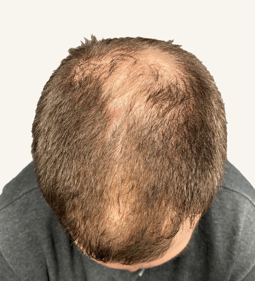 Before hair restoration