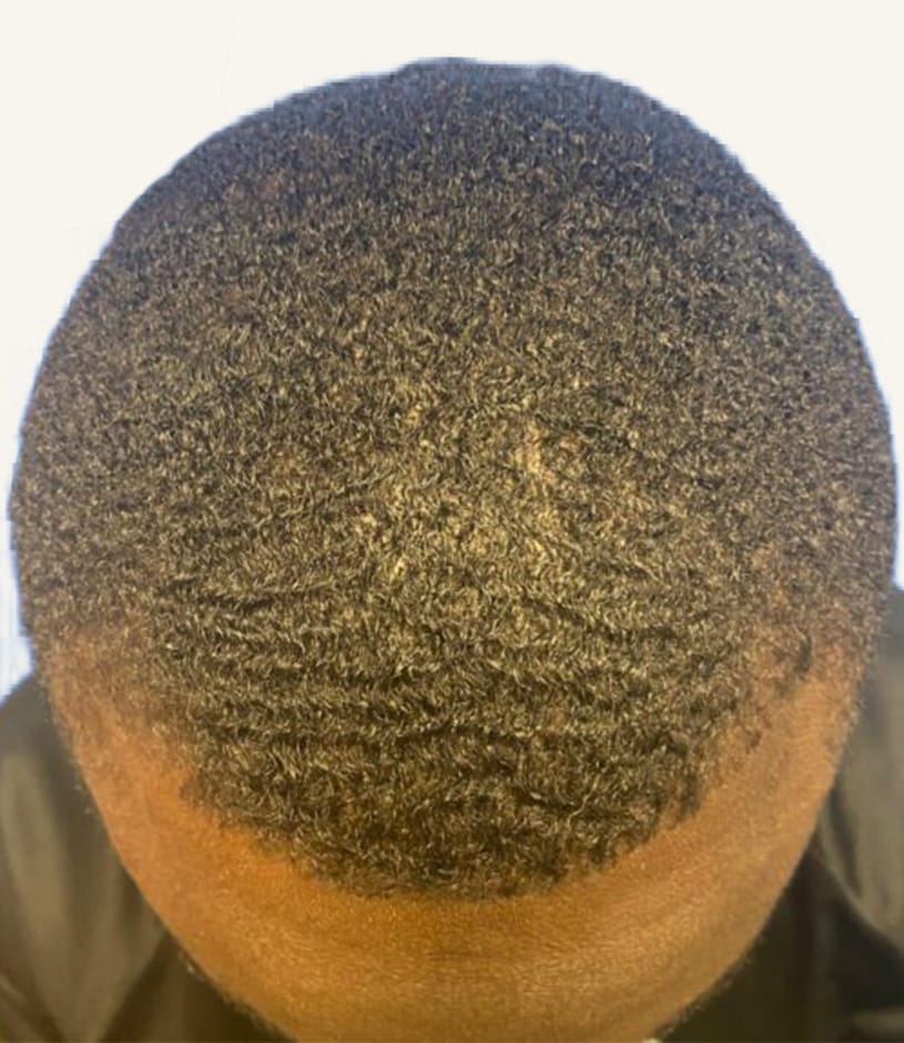 After hair restoration