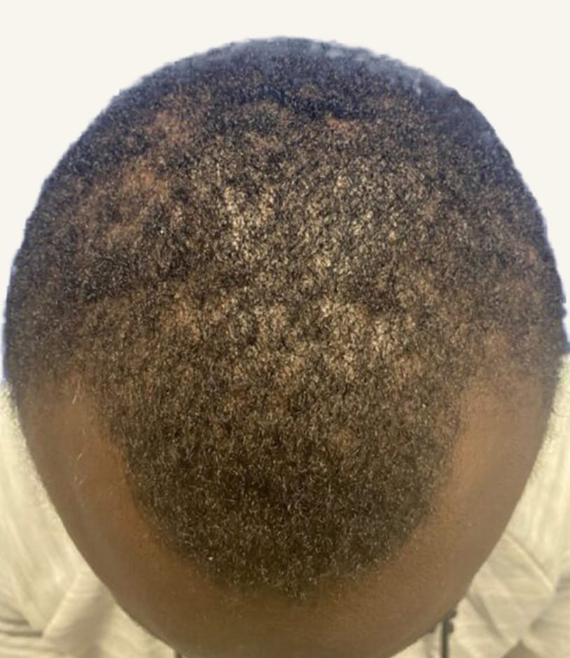 Before hair restoration