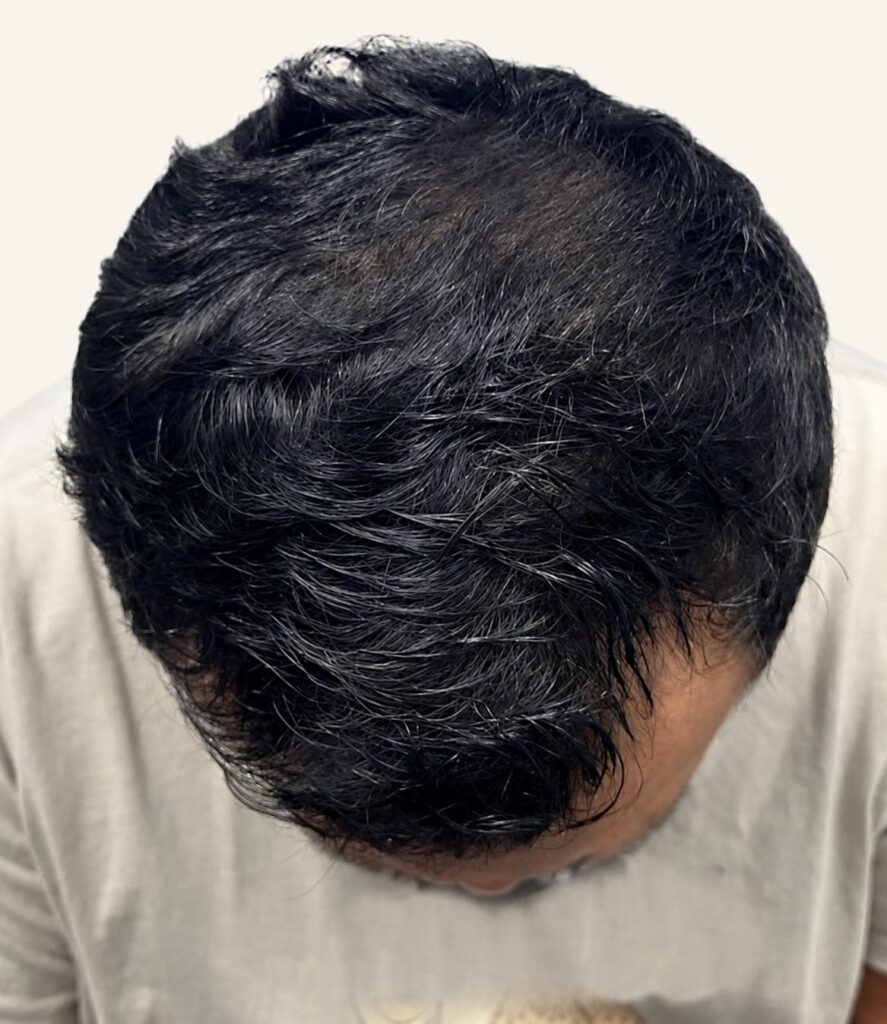 After hair restoration