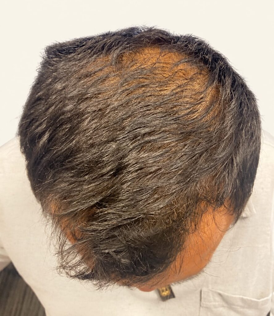 Before hair restoration