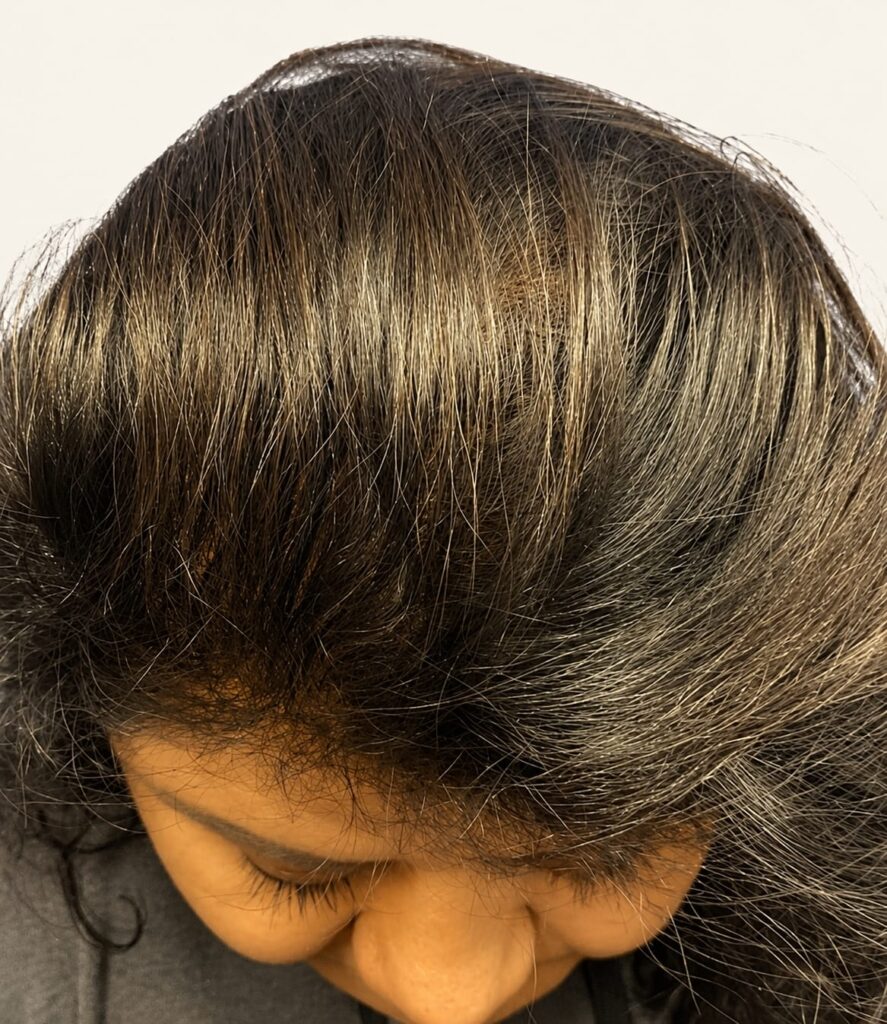 After hair restoration