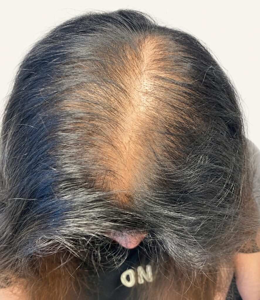 Before hair restoration