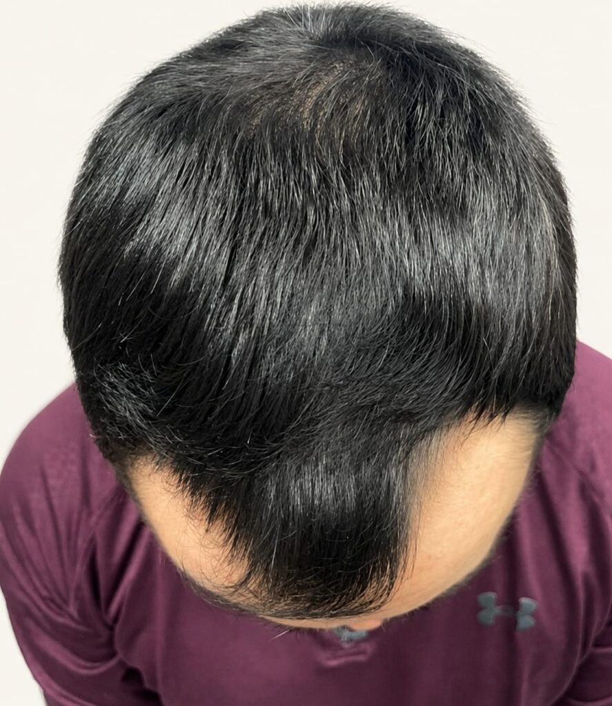 After hair restoration