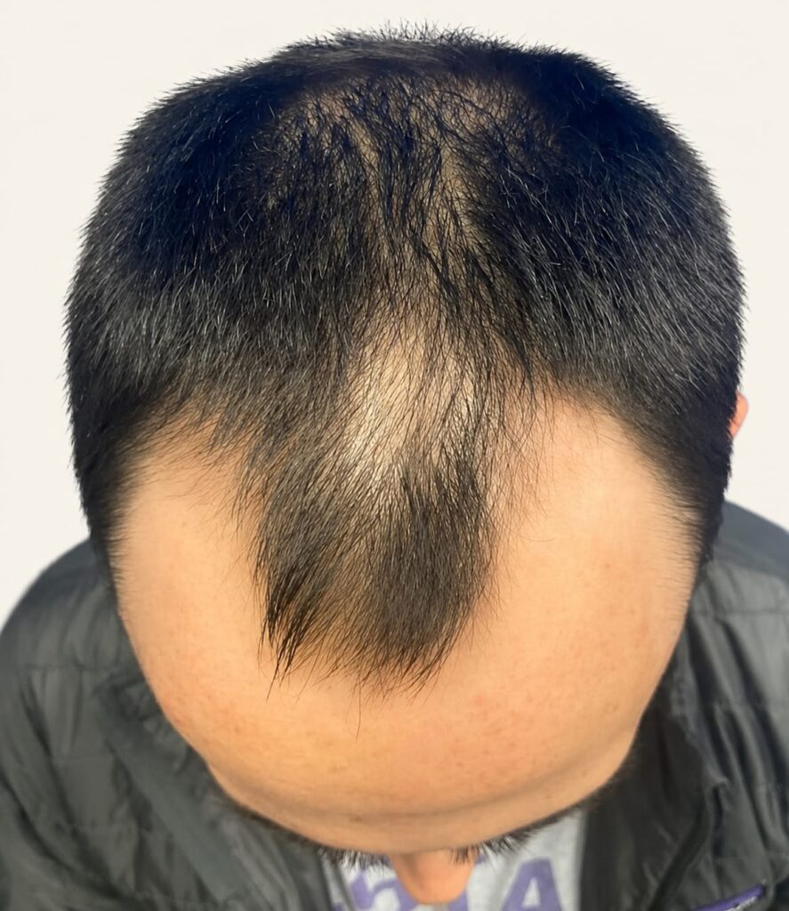 Before hair restoration