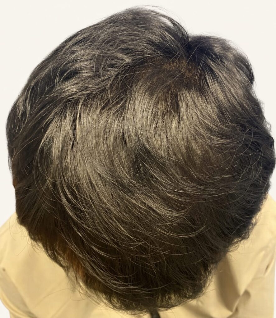 After hair restoration