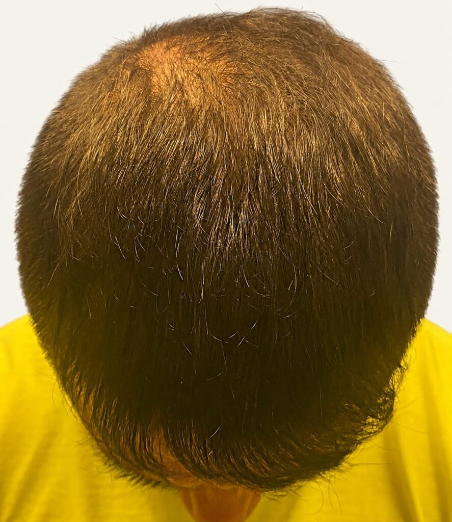 After hair restoration