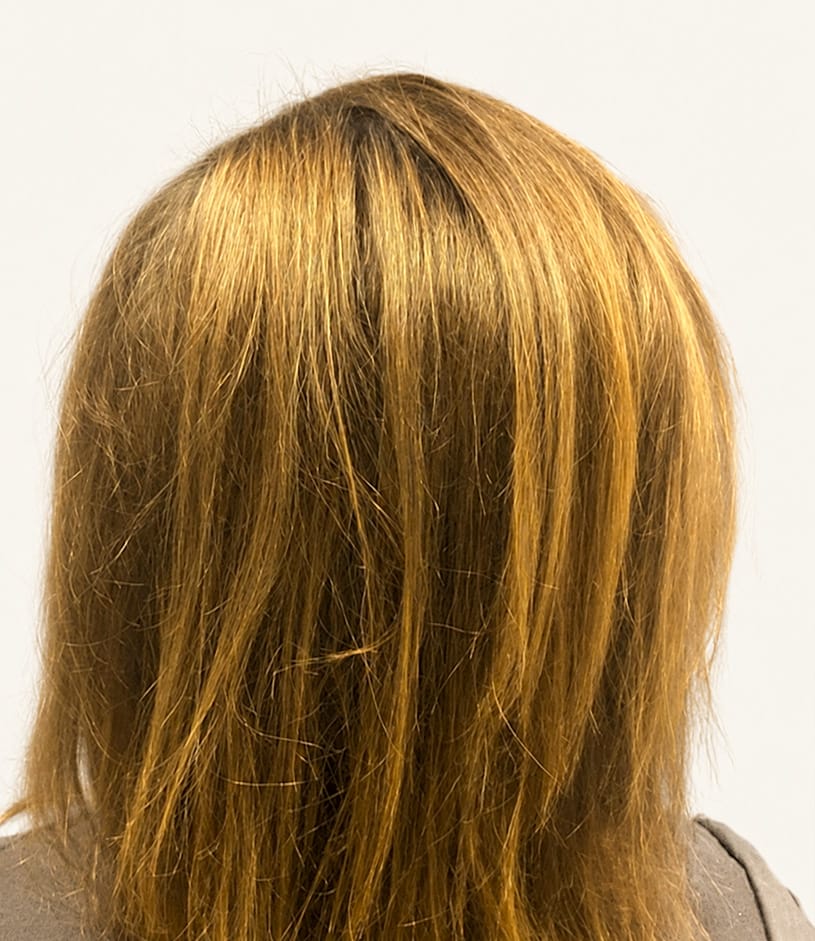 After hair restoration