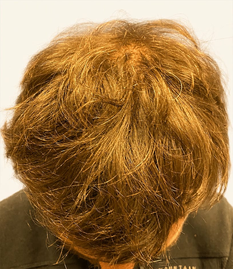 After hair restoration