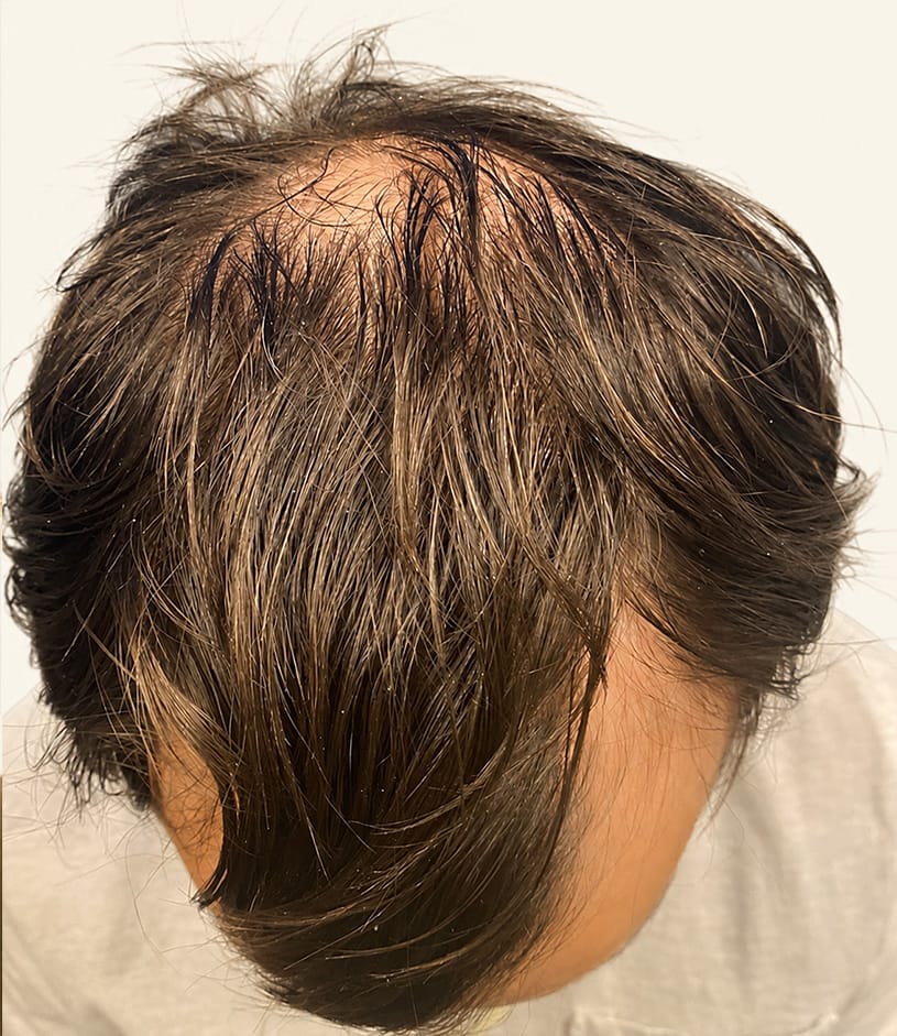 Before hair restoration