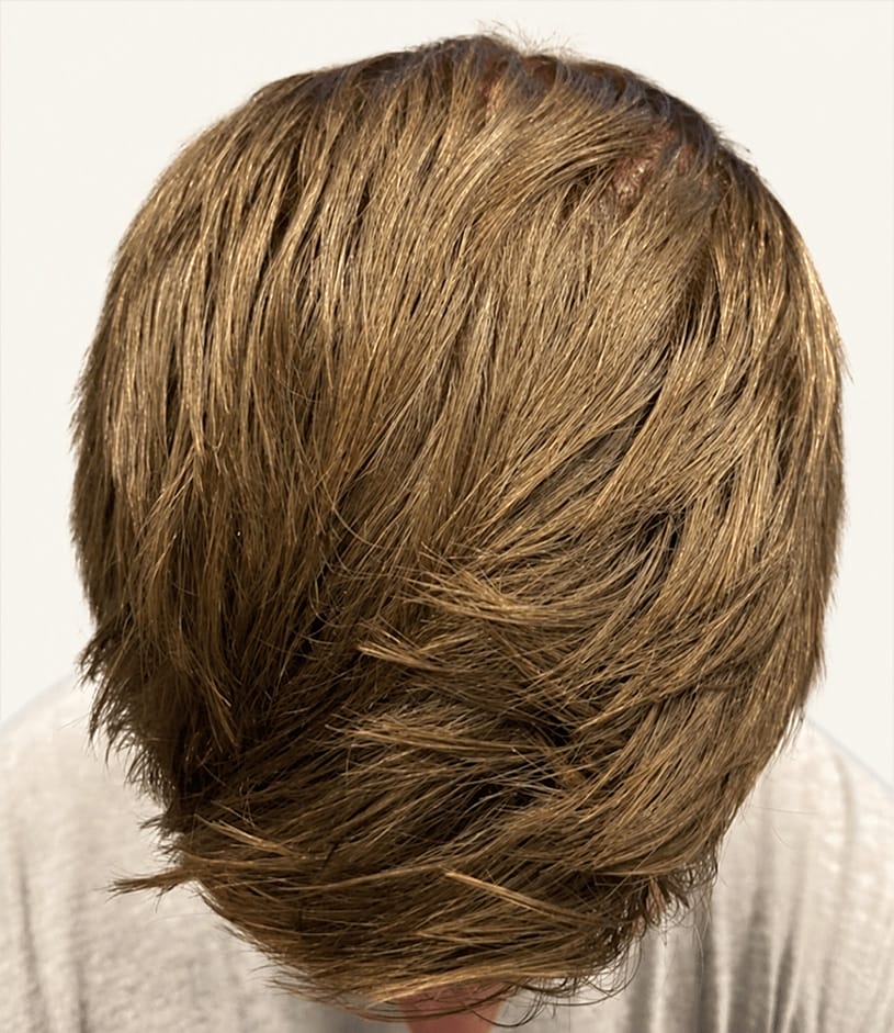 After hair restoration