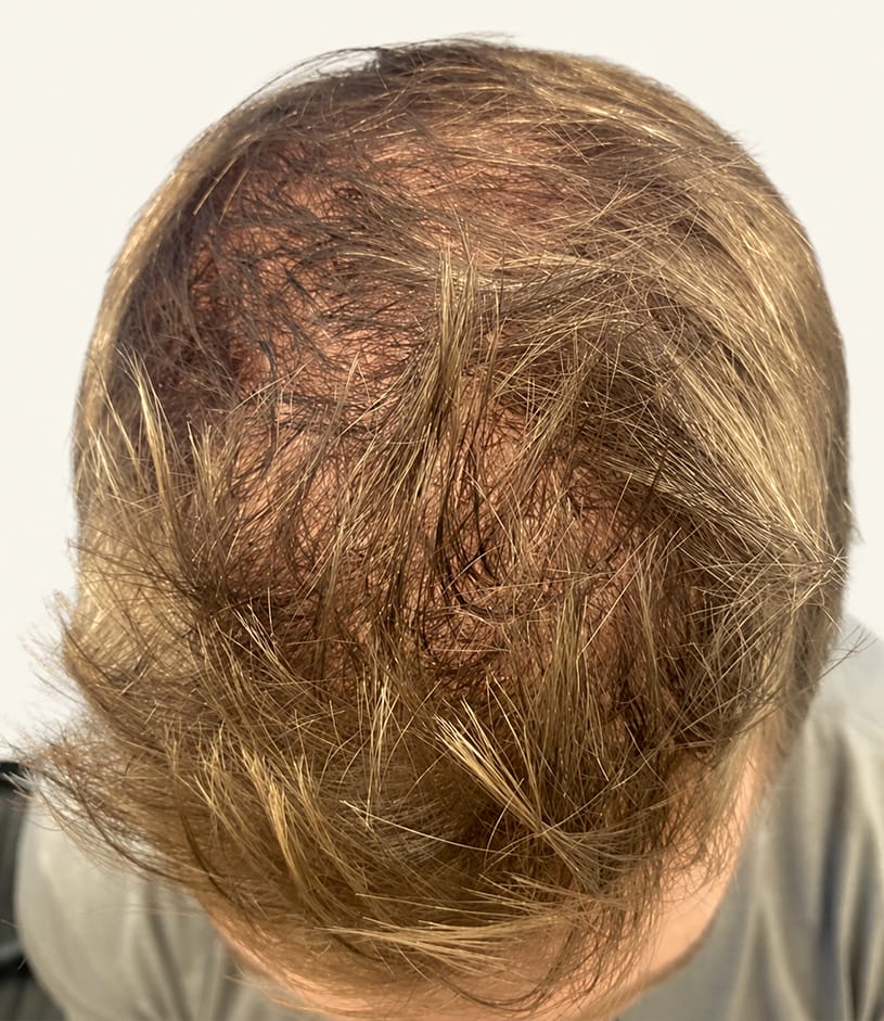 Before hair restoration