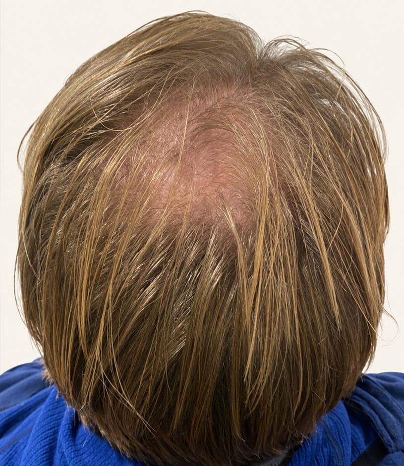 Before hair restoration