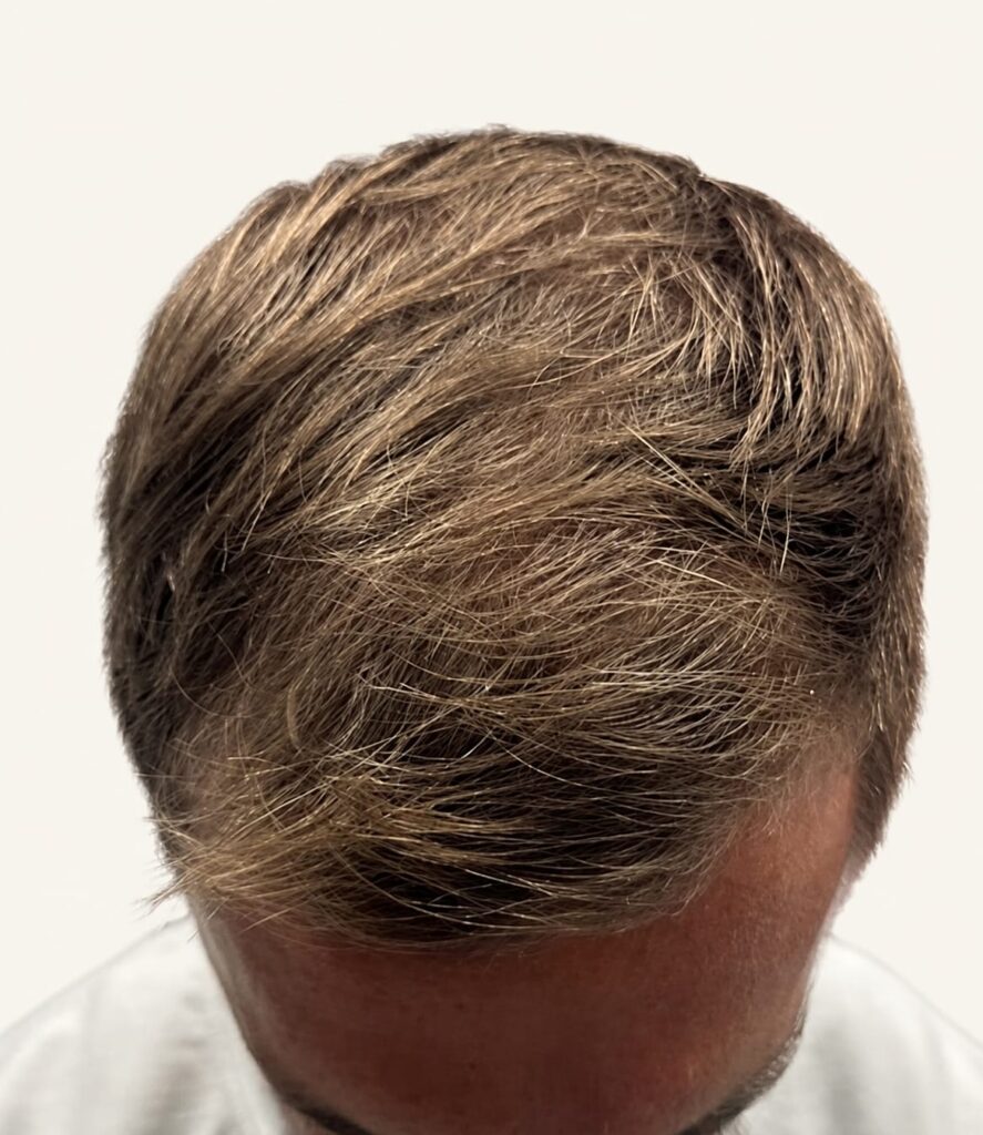 After hair restoration