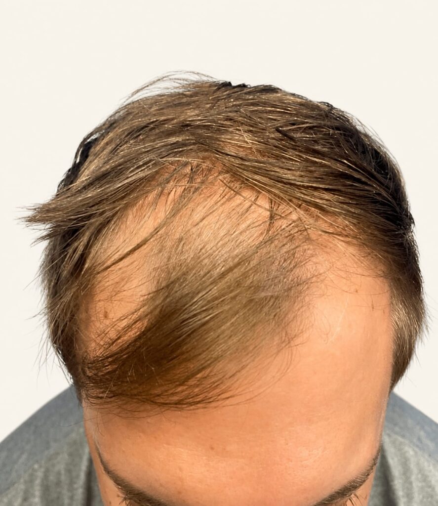 Before hair restoration