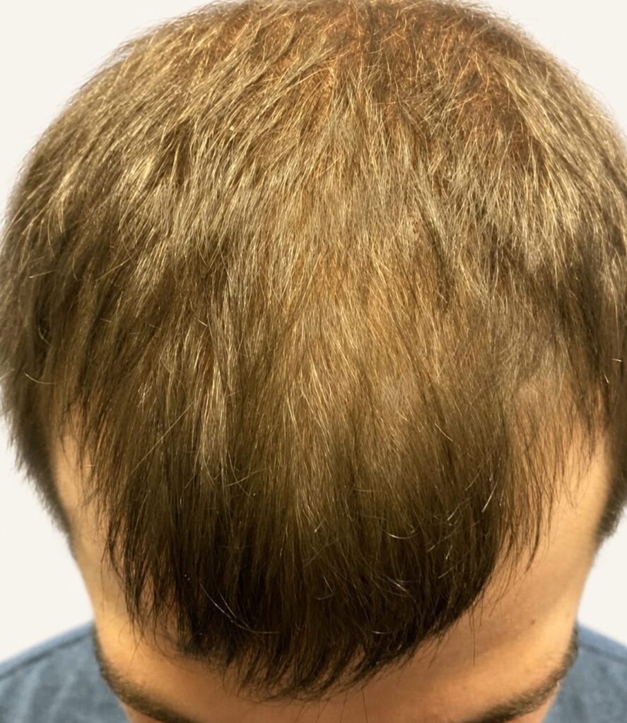 After hair restoration