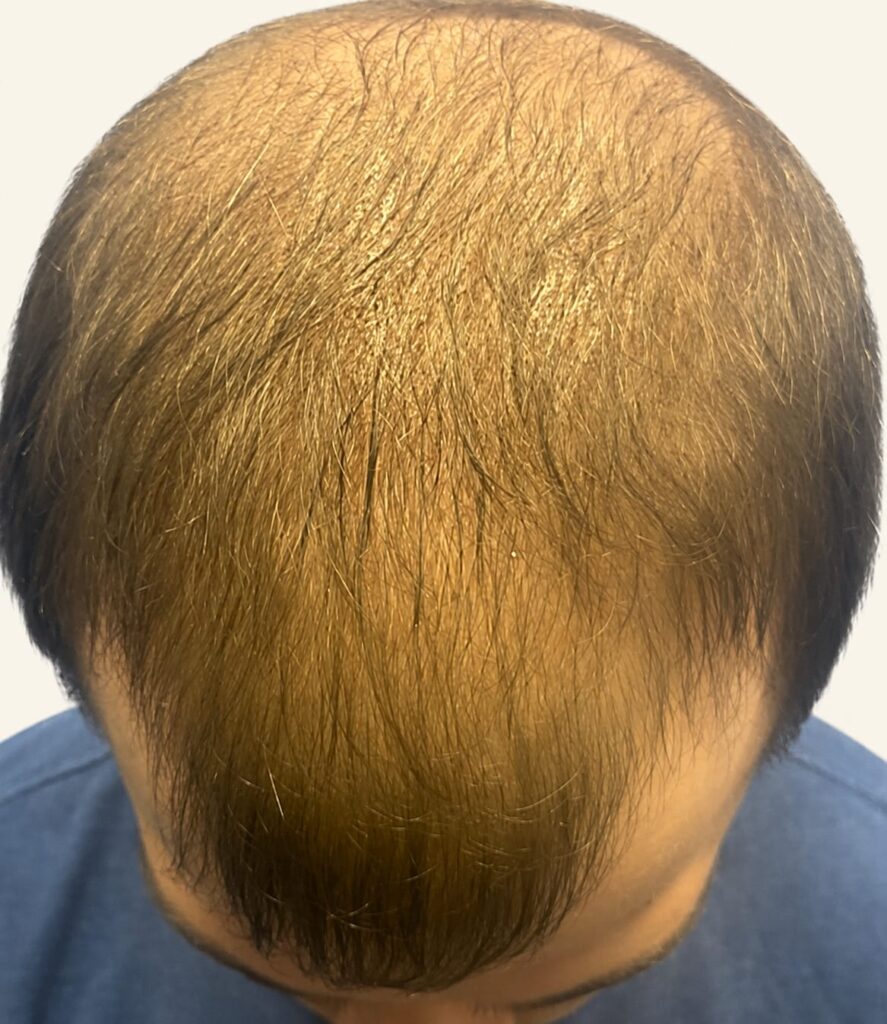 Before hair restoration
