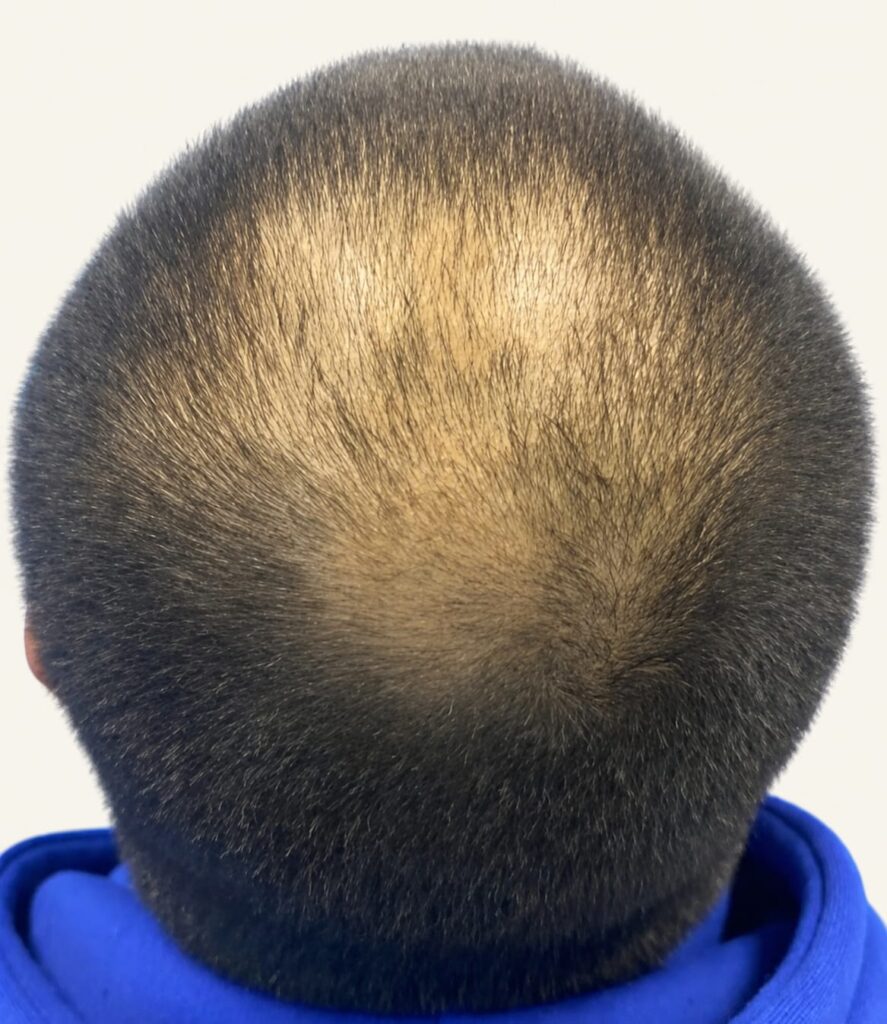 After hair restoration