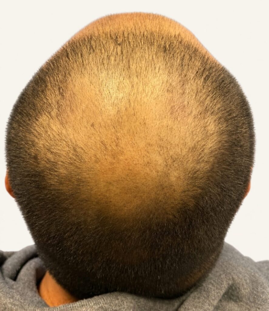 Before hair restoration