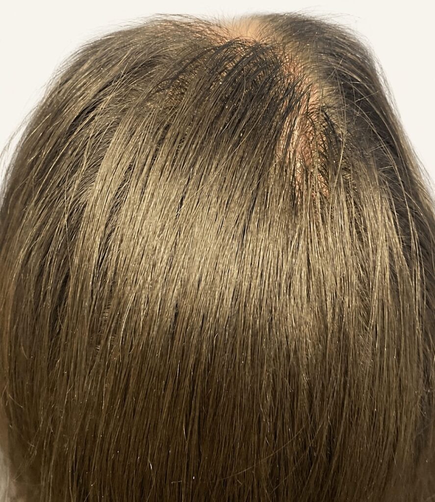 After hair restoration